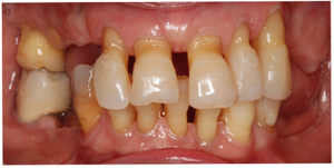 Imagen de una dentadura con enfermedad periodontal en la que se observa la migración dental patológica debido a la disminución de soporte del periodonto