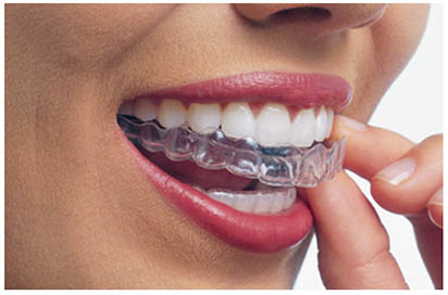 Imagen una dentadura con alineadores transparentes para ilustrar el precio Invisalign