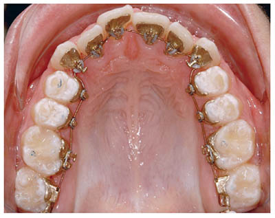 Imagen una dentadura con brackets linguales para ilustrar cuanto cuesta la ortodoncia con brackets linguales