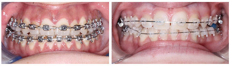 Imagen que muestra una dentadura con brackets metálicos y otra con brackets estéticos para ilustrar la diferencia de precio de los brackets