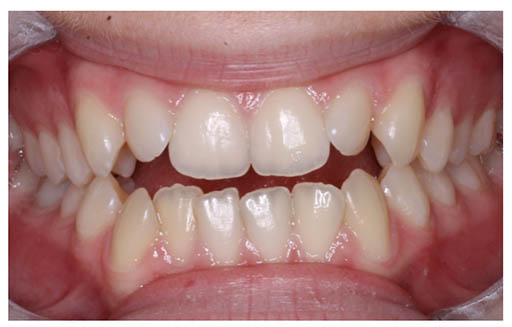 Imagen de una dentadura con mordida abierta anterior