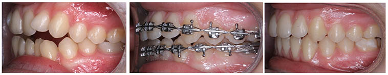 Imagen de dentadura con mordida abierta dentaria con tratamiento de ortodoncia fija convencional