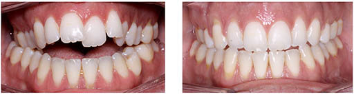 Imagen de dentadura con mordida abierta esquelética corregida sin cirugía con tratamiento de ortodoncia fija convencional
