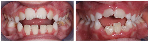 Imagen de dos dentaduras con mordida abierta en niños