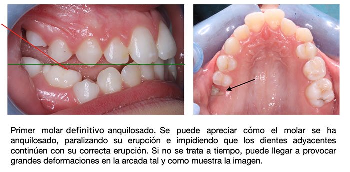 Imágenes que muestran las consecuencias de la anquilosis dental: el diente anquilosado se queda hundido impidiendo que los dientes adyacentes crezcan