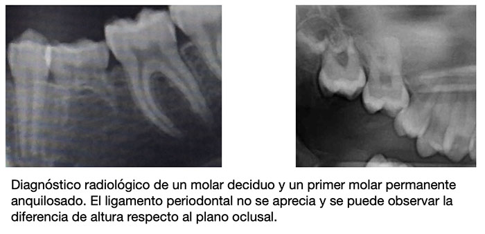 Imagen de radiografías que muestran de dientes anquilosados