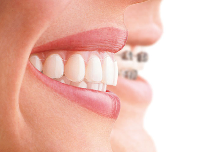 Imagen ortodoncia invisalign y brackets para introducir post Técnicas para mejorar la higiene bucodental con ortodoncia