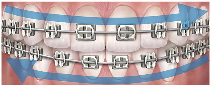 Primer plano de una dentadura con ortodoncia fija y flechas que indican la dirección del cepillado para una buena higiene oral en ortodoncia