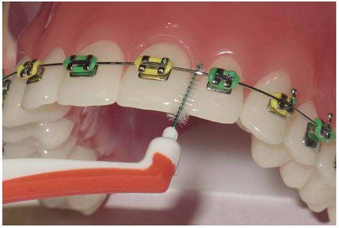 Primer plano de un cepillo interdental entre el alambre de la ortodoncia fija y el diente
