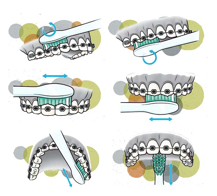 Secuencia del cepillado de dientes con ortodoncia fija que muestra cómo cepillar todas las caras del diente    
