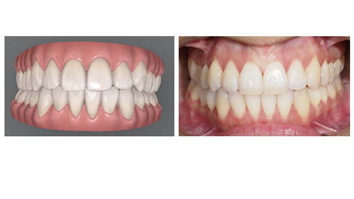 Ejemplo del resultado del tratamiento de apiñamiento inferior distalando toda la arcada inferior y alineando los dientes
