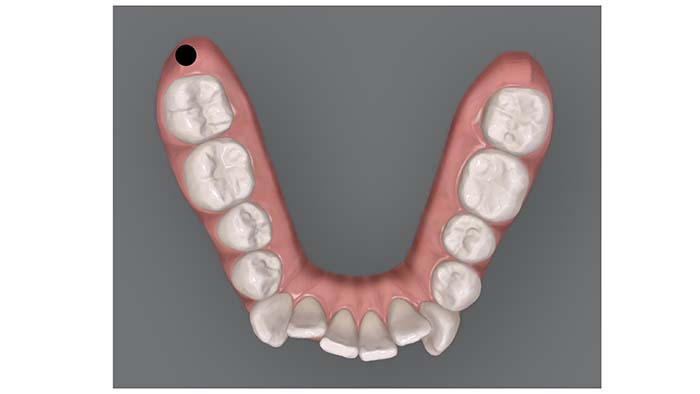 Primer plano dentadura con ejemplo de distalización de toda la arcada inferior con microtornillos colocados detrás de los segundos molares inferiores