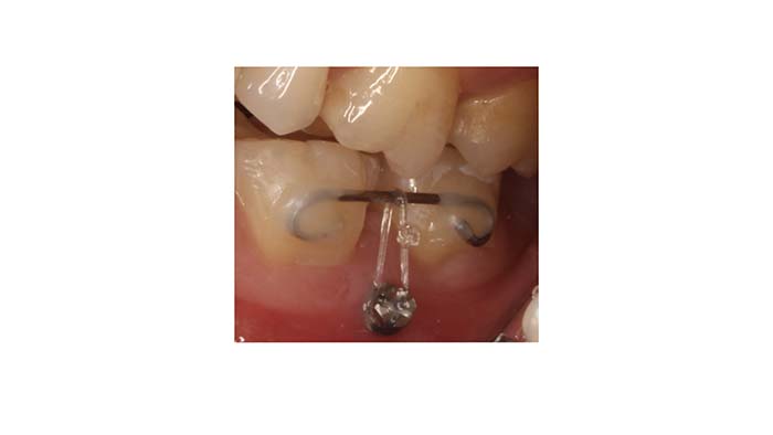 Primer plano de la colocación de un microtornillo entre el primer y segundo molar inferior izquierdo