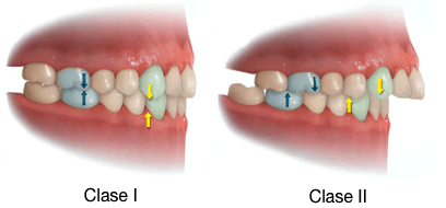 Simulación 3D de la correcta oclusión clase I y de la maloclusión clase II de la protrusión dental

