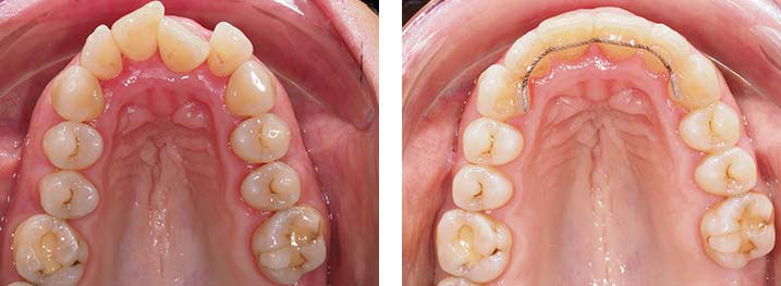 Primer plano de la secuencia antes y después del tratamiento de ortodoncia para alienar los dientes superiores torcidos