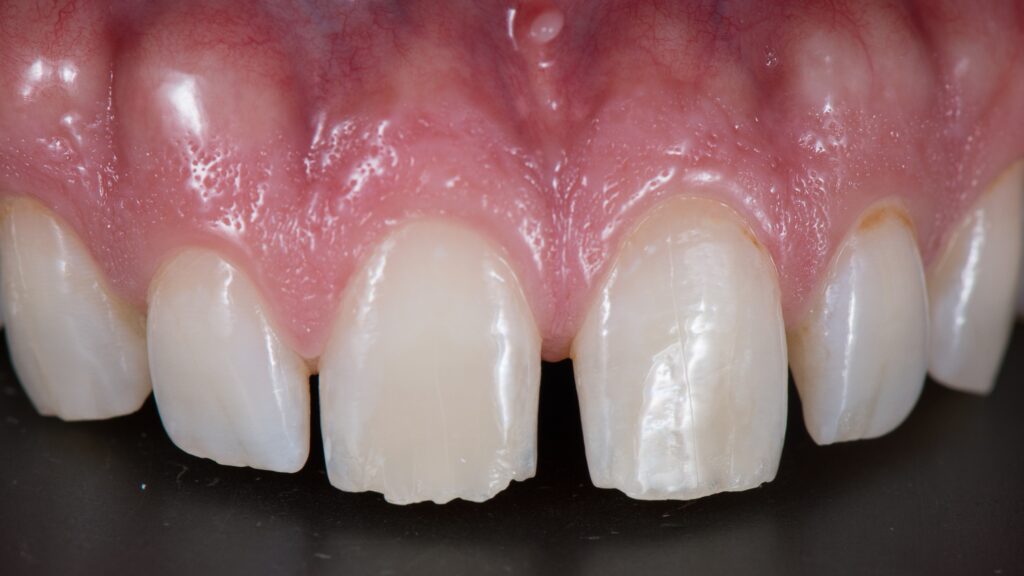 diastema