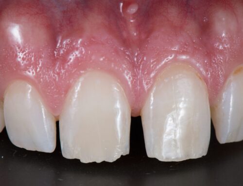 Diastema: qué es, su relación con el frenillo labial y tratamientos