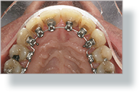 Orthodontics Tres Torres Barcelona results real case