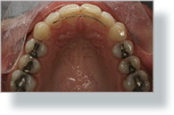 Orthodontics Tres Torres Barcelona results real case