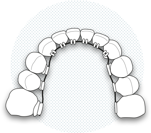 Illustration of lingual brackets