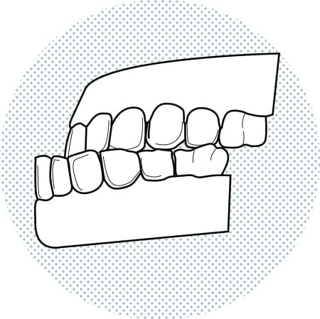 Il·lustració de dents inferiors més avançats que els superiors