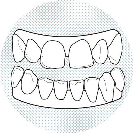 Il·lustració d'una dentadura amb les dents separades