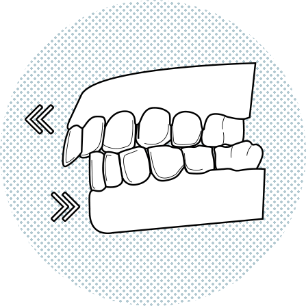 Illustration of upper front teeth protruding above the lower
