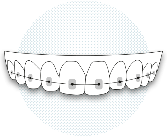Ortodoncia con brackets