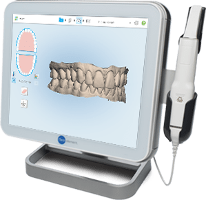 Lingual orthodontic treatment starts by taking very accurate digital impressions of the teeth in 3D