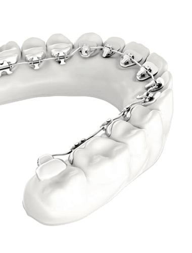 What is lingual orthodontics: lingual brackets placed on the inside of the teeth to correct their position