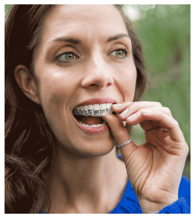 Close-up of a patient undergoing Invisalign® orthodontic treatment easily inserting her aligners.
