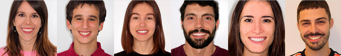 Close-up of patients of Ortodoncia Tres Torres to present Invisalign before and after.